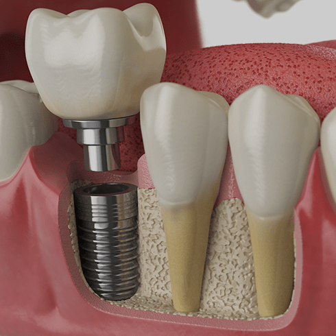 Treatment - Dentaliving