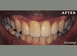 After - dentaliving