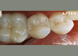 After - dentaliving